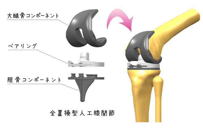 人工膝関節置換術イメージ